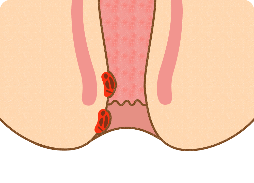 痔核（いぼ痔）の原因