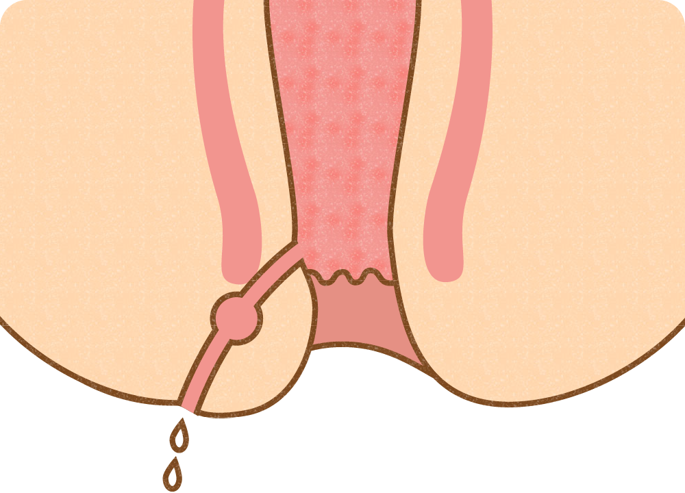 痔瘻（あな痔）の原因