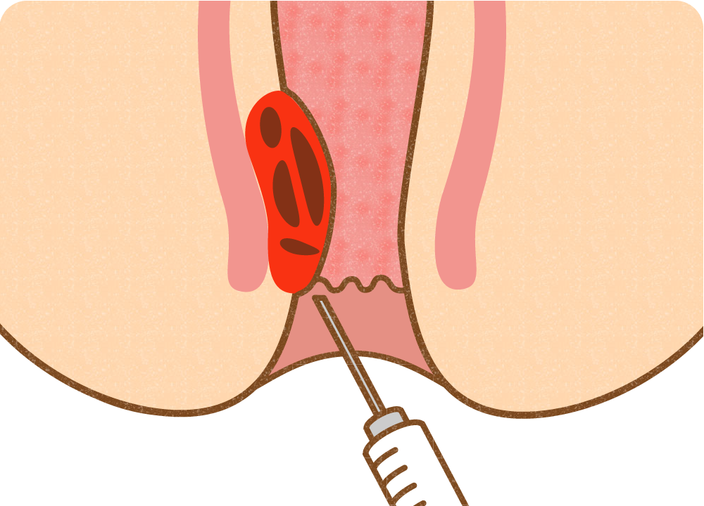ジオンの４段階注射法