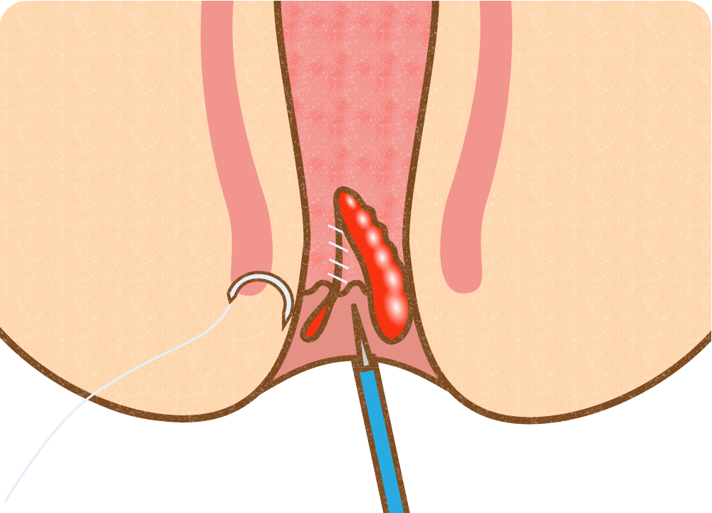 手術法（肛門形成術）